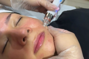 Ionización facial